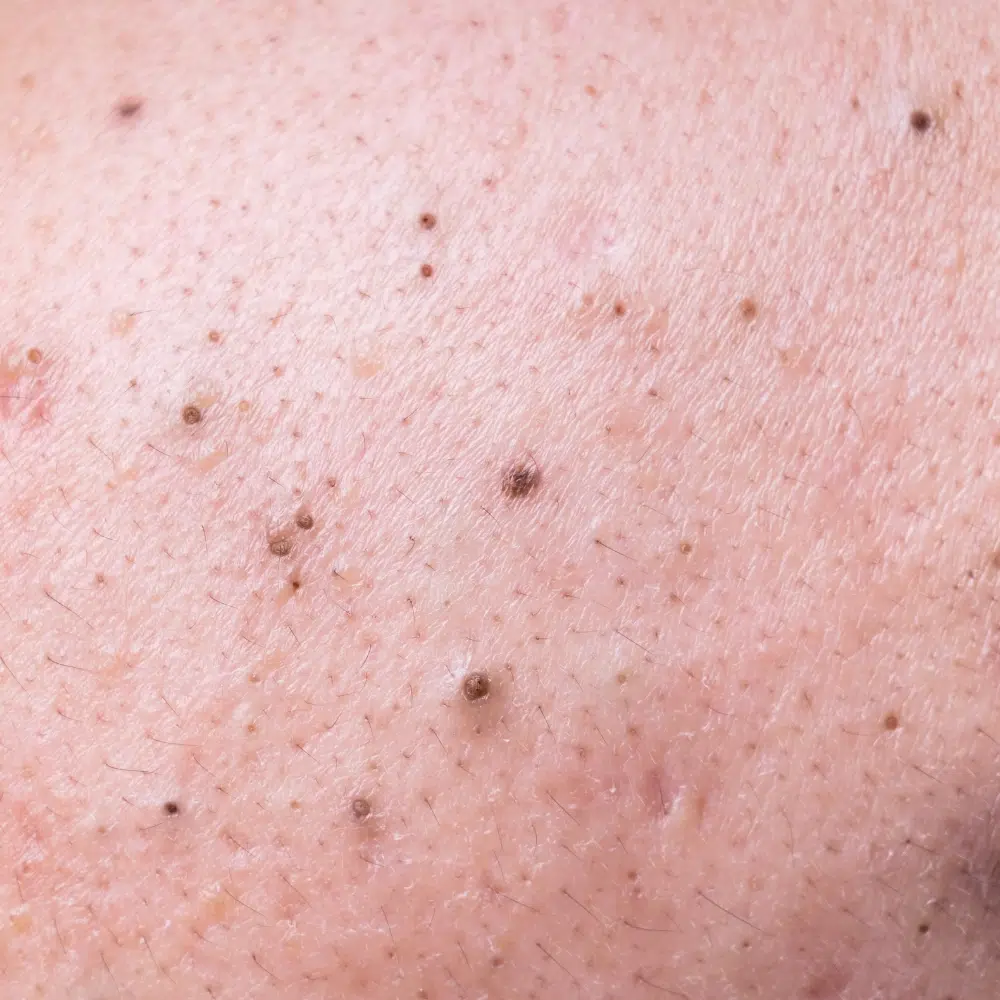 Blackheads on skin