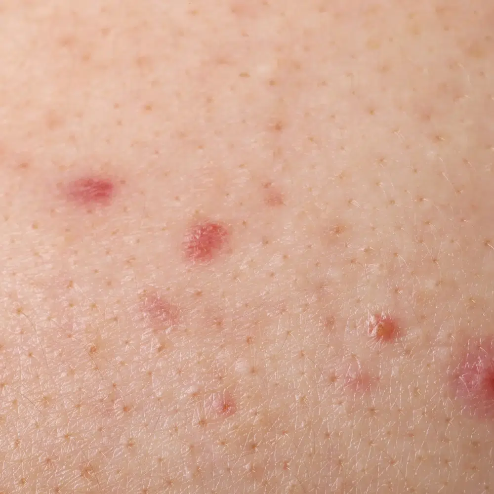Papules on skin