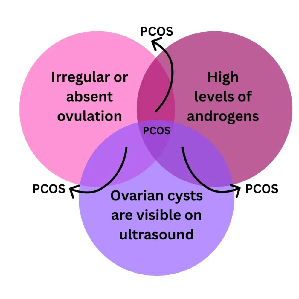 venn diagram showing the Rotterdam Criteria used to diagnose PCOS.